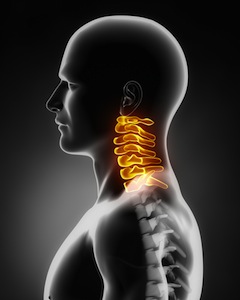 Herniated Cervical Disc