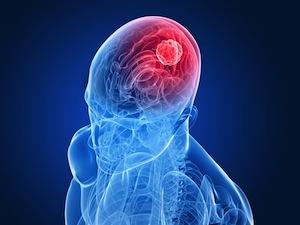 Cerebral Palsy